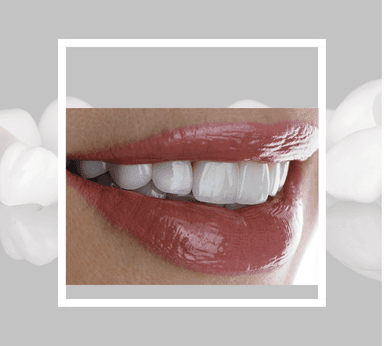 E-max Kaplamalar (hangi dişlere uygulanabilir, süreç)